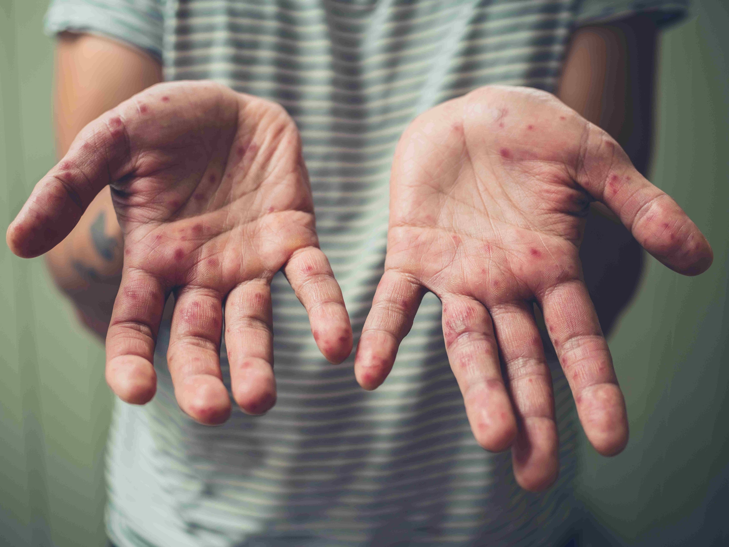 Immagine: Morbillo