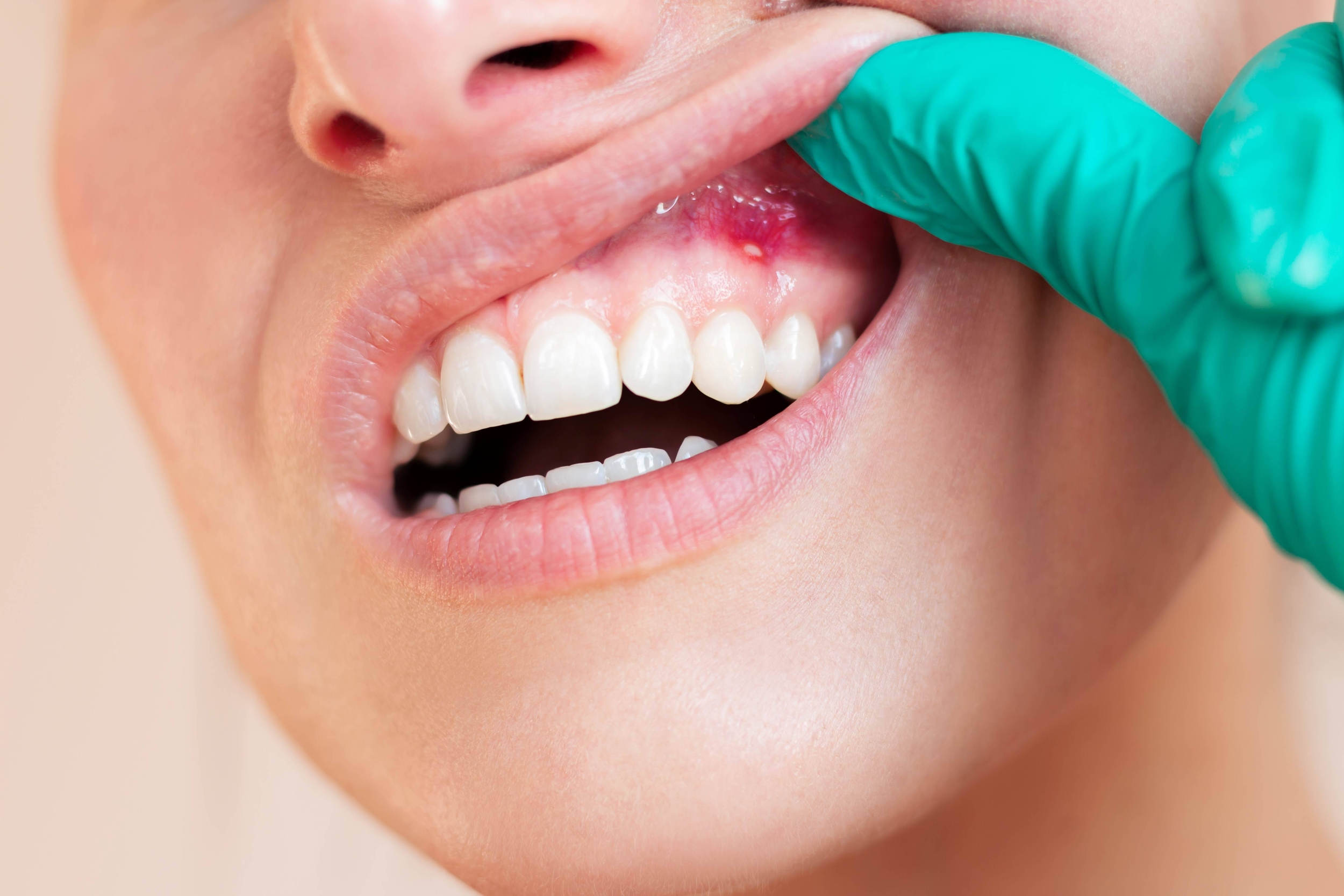 Immagine: Patologia orale